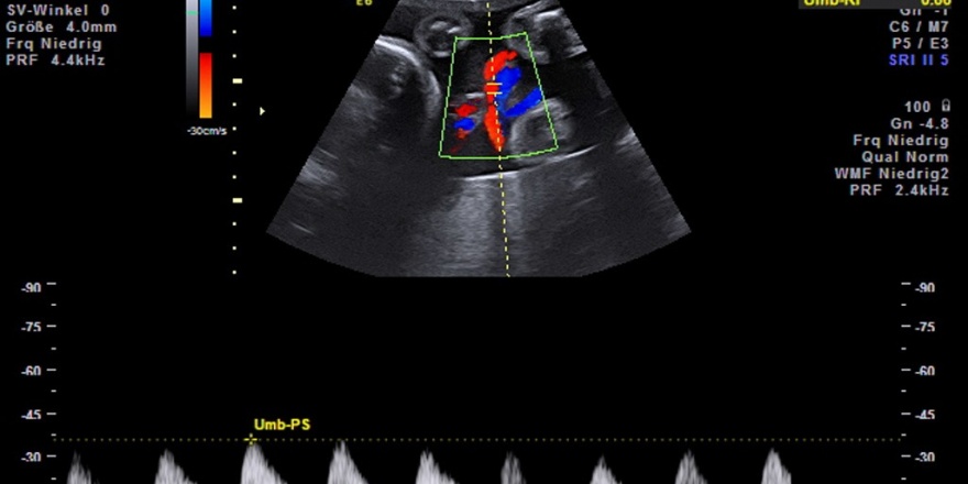 Doppler&shy;sonographie - Frauenarzt Augsburg Dr. Fischer & Kirschbaum