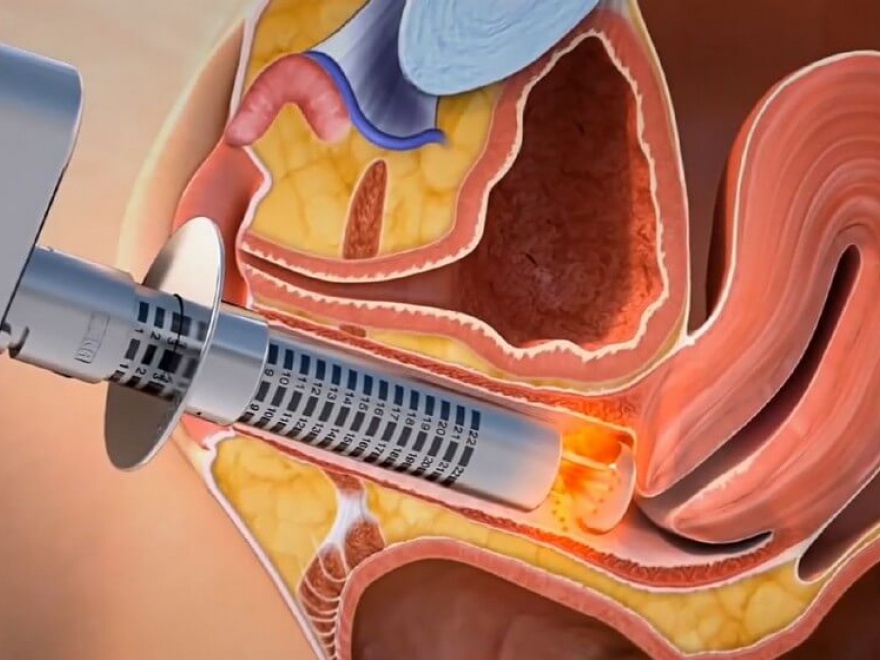 MonaLisa Touch®: neue Behandlungsform zur Verbesserung der vaginalen Gesundheit - Frauenarzt Augsburg Dr. Fischer & Kirschbaum