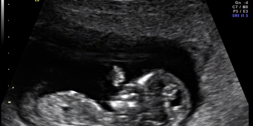 Zertifiziertes Ersttrimester-Screening - Frauenarzt Augsburg Dr. Fischer & Kirschbaum