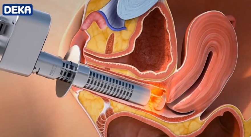 MonaLisa Touch® - Frauenarzt Augsburg Dr. Fischer & Kirschbaum